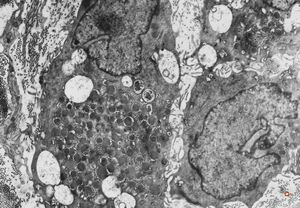 M,40y. | granular cell tumor M,40y. | granular cell tumor